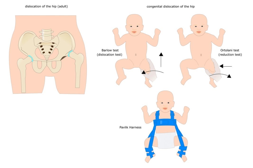 Developmental Dysplasia of the Hip DRHC Dubai Pediatric Orthopedic